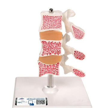 1. Arthritis and Osteoporosis