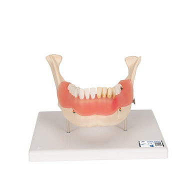 Dental Disease Model, 2x magnified, 21 parts