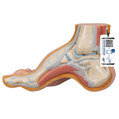 Hollow Foot (Pes Cavus)