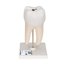 Lower Twin-Root Molar Showing Cavities, 2 part