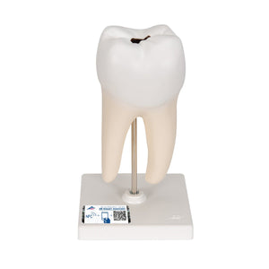 Lower Twin-Root Molar Showing Cavities, 2 part