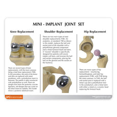 Mini Implant Joint Set