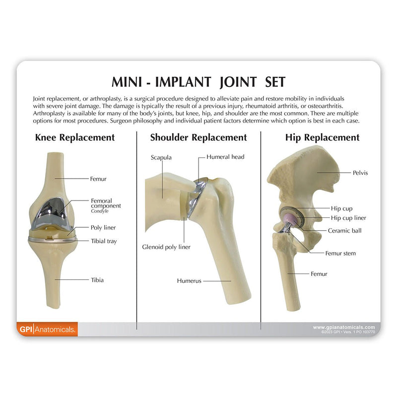 Mini Implant Joint Set