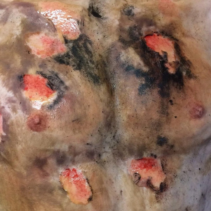 Realistic Male Burned Torso Overlay with 2nd-3rd Degree Scalding Burns