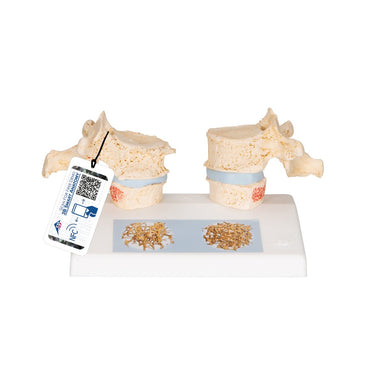 Osteoporosis Model