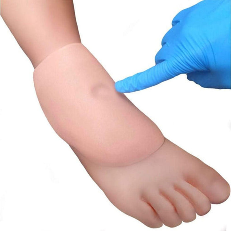 Pair Of Sticky Pitting Edema