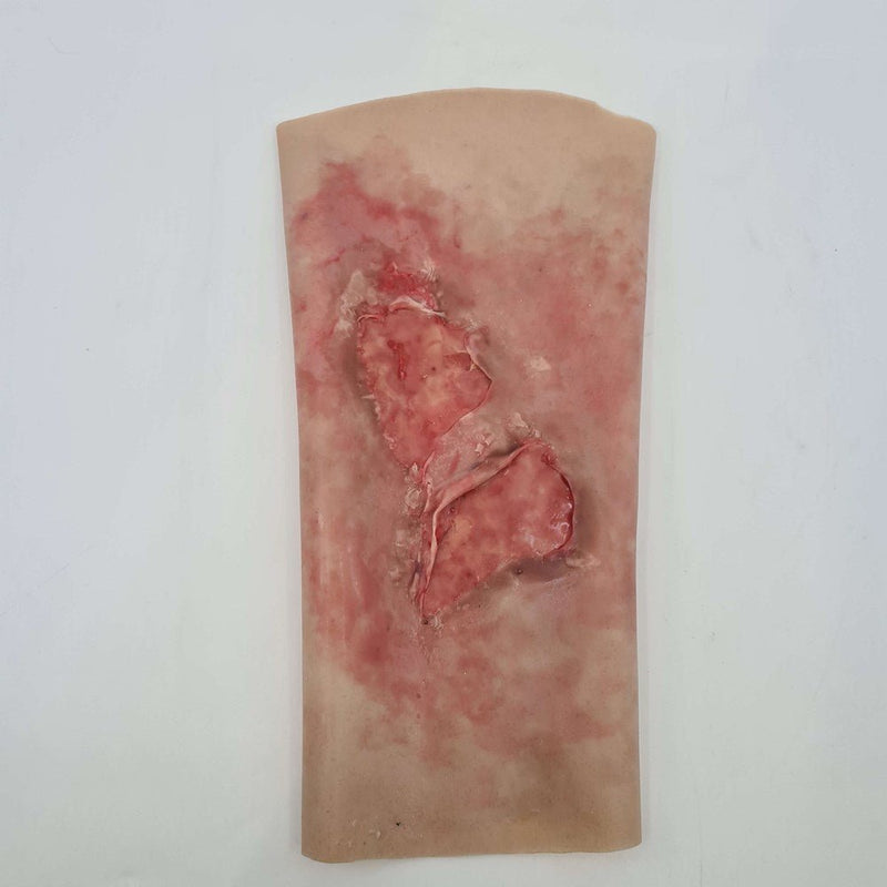 Scalding Burn Sleeve