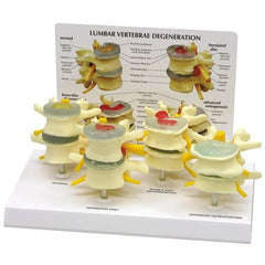 4-Stage of Osteoporosis Vertebrae Model