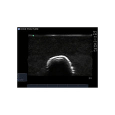 Bone Fracture Ultrasound Training Block, Crepitus Fracture