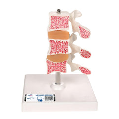 Deluxe Osteoporosis Model