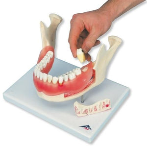 Dental Disease Model, 2x magnified, 21 parts