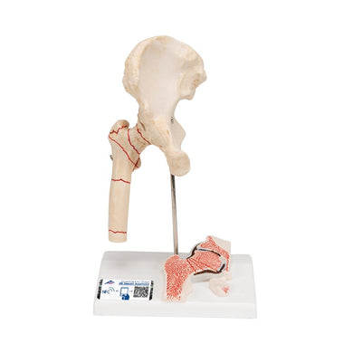 Femoral Fracture and Hip Osteoarthritis Model