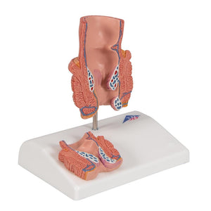 Hemorrhoid Model