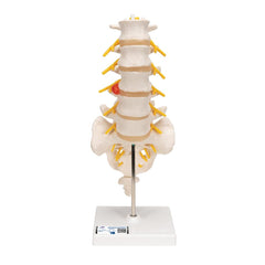 Lumbar Spinal Column with Dorso-lateral Prolapsed Intervertebral Disc