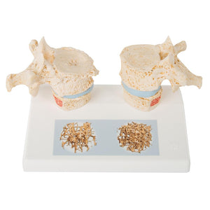 Osteoporosis Model