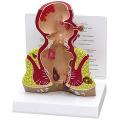 Rectum Cross Section Model with Pathologies