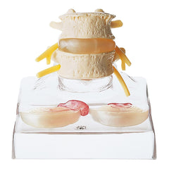 SOMSO Central and Dorsolateral Hernia Model of Intervertebral Disc