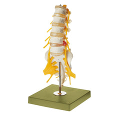 Lumbar Spinal Column with Dorso-lateral Prolapsed Intervertebral Disc –