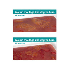 Wound Moulage 2nd Degree Burn Kit