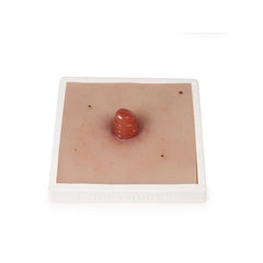 Wound Moulage Ileostoma, incl. Stand